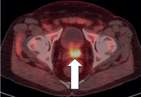 Understanding and Improving <sup>18</sup>F-Fluciclovine PET/CT Reports: A Guide for Physicians Treating Patients with Biochemical Recurrence of Prostate Cancer.