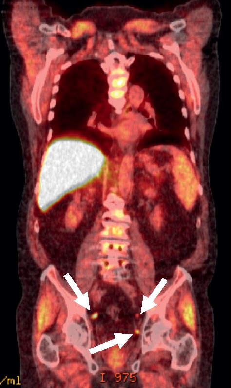 Understanding and Improving <sup>18</sup>F-Fluciclovine PET/CT Reports: A Guide for Physicians Treating Patients with Biochemical Recurrence of Prostate Cancer.