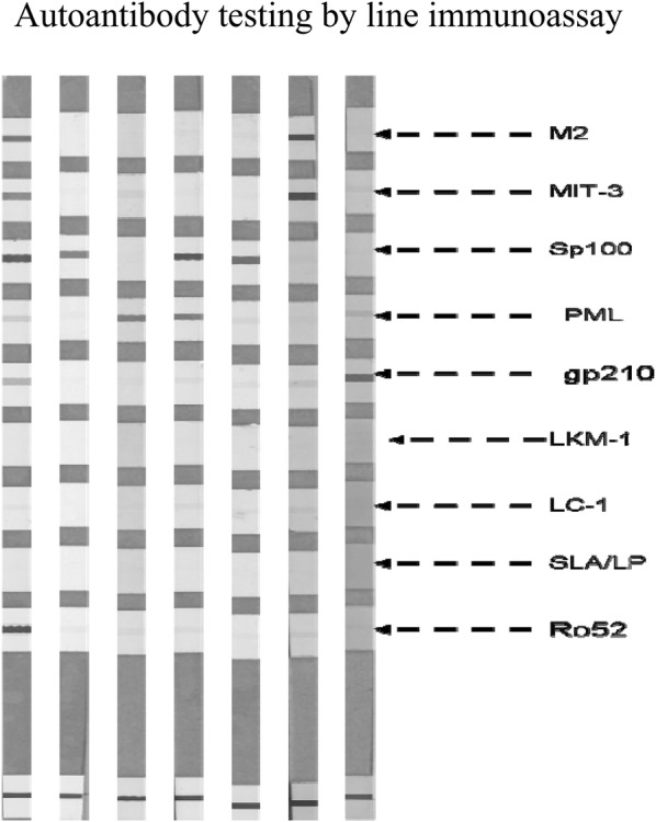 A comprehensive analysis of antigen-specific autoimmune liver disease related autoantibodies in patients with multiple sclerosis.