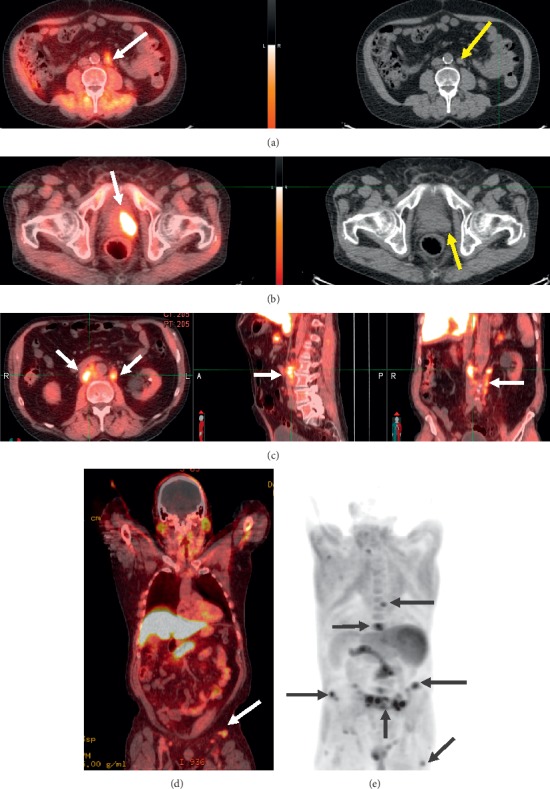 Understanding and Improving <sup>18</sup>F-Fluciclovine PET/CT Reports: A Guide for Physicians Treating Patients with Biochemical Recurrence of Prostate Cancer.