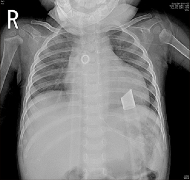 The First Pediatric Heart Transplantation Bridged by a Durable Left Ventricular Assist Device in Korea.