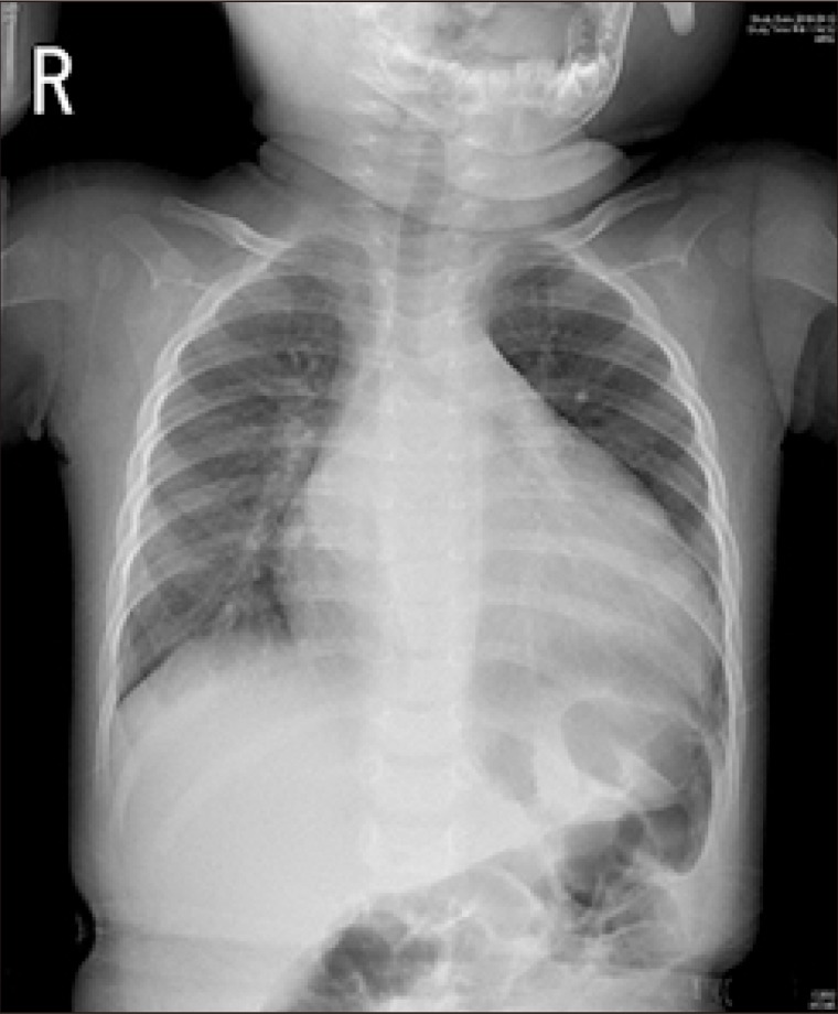 The First Pediatric Heart Transplantation Bridged by a Durable Left Ventricular Assist Device in Korea.