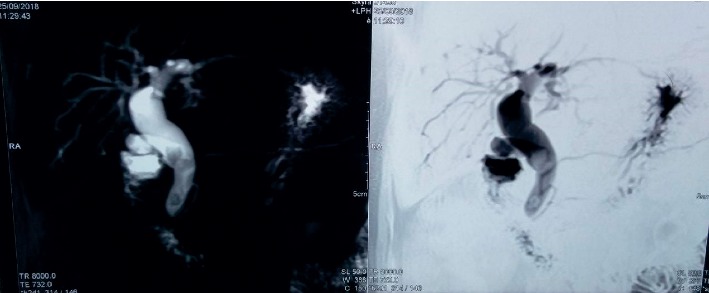 Management of Choledochal Cysts at a Tertiary Care Centre: A Nine-Year Experience from India.