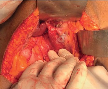 Management of Choledochal Cysts at a Tertiary Care Centre: A Nine-Year Experience from India.