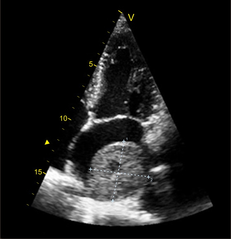Functional Intracardiac Paraganglioma.