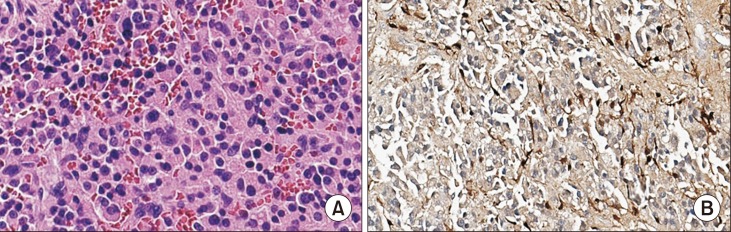 Functional Intracardiac Paraganglioma.