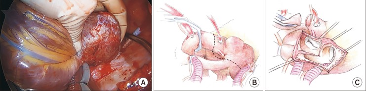 Functional Intracardiac Paraganglioma.