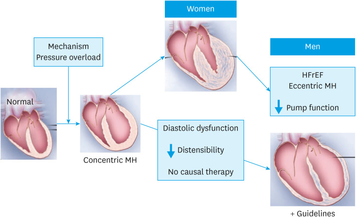 Sex and Gender Differences in Heart Failure.