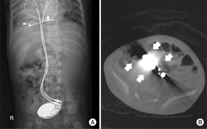 A Case Report of Rare Complications after Epicardial Permanent Pacemaker Implantation in an Infant: Airway Compression, Skin Necrosis, and Bowel Perforation.