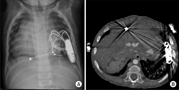 A Case Report of Rare Complications after Epicardial Permanent Pacemaker Implantation in an Infant: Airway Compression, Skin Necrosis, and Bowel Perforation.