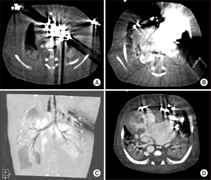 A Case Report of Rare Complications after Epicardial Permanent Pacemaker Implantation in an Infant: Airway Compression, Skin Necrosis, and Bowel Perforation.