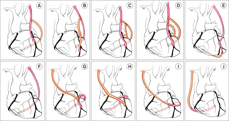 Outcomes and Patency of Complex Configurations of Composite Grafts Using Bilateral Internal Thoracic Arteries.