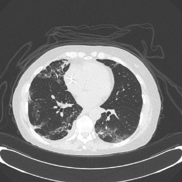 Pulmonary Complications Secondary to Immune Checkpoint Inhibitors.