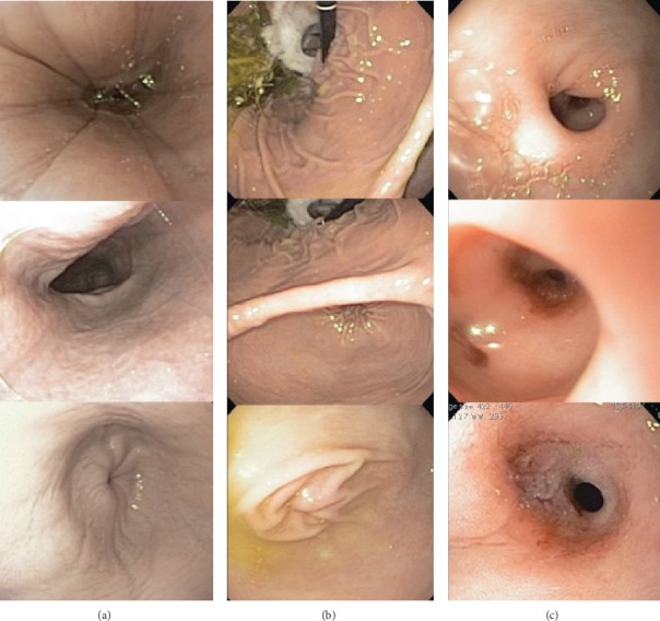 Benign Duodenal Stricture Treated with Surgical Correction and Dietary Therapy in a Golden Retriever.