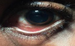 Nonsurgical management of photoaversive ocular and systemic loiasis in Michigan.