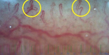 The Comparison of Nailfold Capillaroscopy between Juvenile Systemic Lupus Erythematosus and Healthy Controls: Correlation with Laboratory and Clinical Parameters.