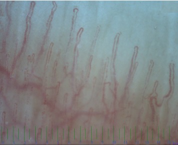 The Comparison of Nailfold Capillaroscopy between Juvenile Systemic Lupus Erythematosus and Healthy Controls: Correlation with Laboratory and Clinical Parameters.