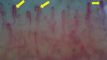 The Comparison of Nailfold Capillaroscopy between Juvenile Systemic Lupus Erythematosus and Healthy Controls: Correlation with Laboratory and Clinical Parameters.