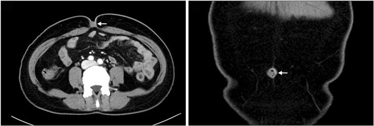 Postmenopausal Spontaneous Umbilical Endometriosis: A Case Report.