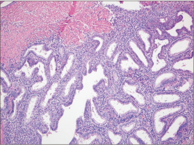 Postmenopausal Spontaneous Umbilical Endometriosis: A Case Report.