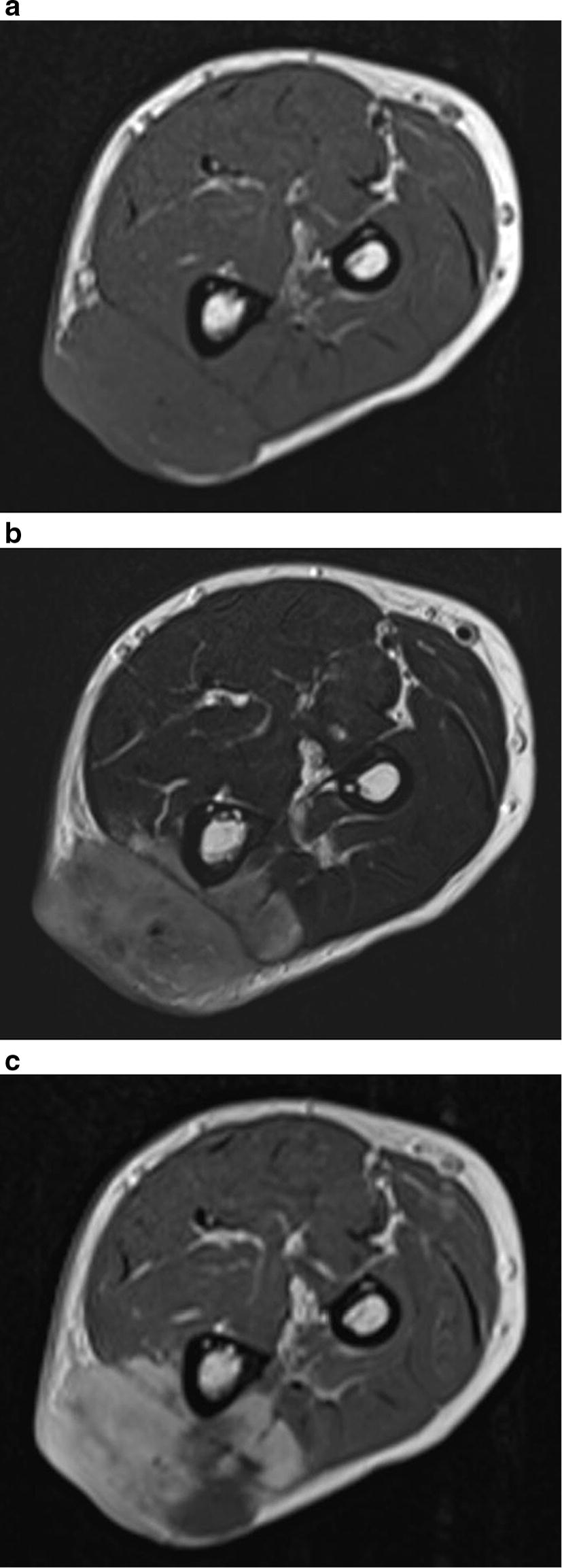 Dedifferentiated soft tissue leiomyosarcoma with heterologous osteosarcoma component: case report and review of the literature.