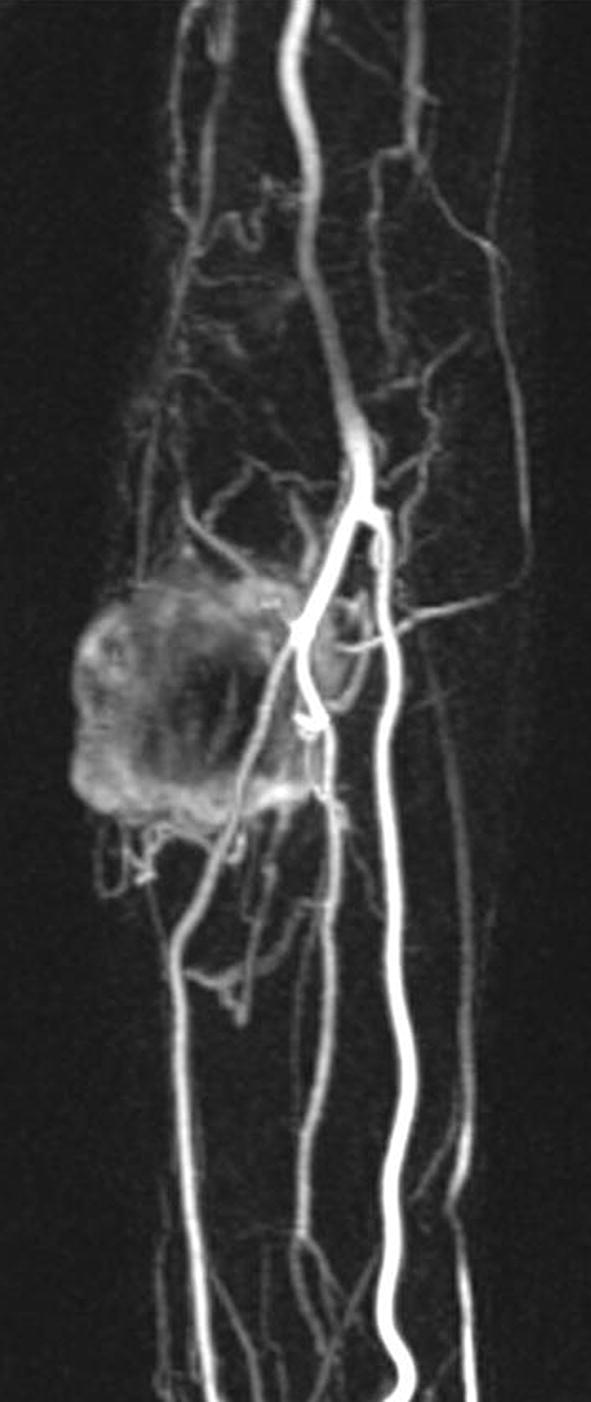 Dedifferentiated soft tissue leiomyosarcoma with heterologous osteosarcoma component: case report and review of the literature.