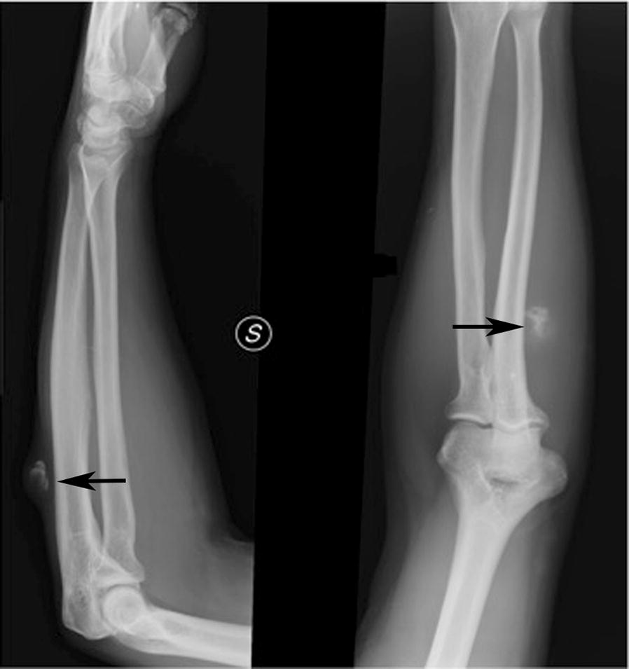 Dedifferentiated soft tissue leiomyosarcoma with heterologous osteosarcoma component: case report and review of the literature.