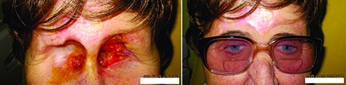 Periocular basal cell carcinoma - clinical perspectives.