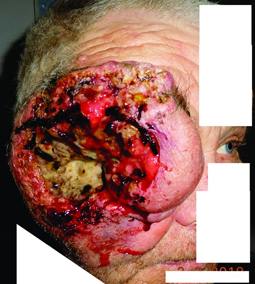 Periocular basal cell carcinoma - clinical perspectives.