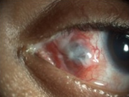 Necrotizing scleritis after strabismus surgery in Treacher Collins syndrome.