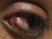 Necrotizing scleritis after strabismus surgery in Treacher Collins syndrome.