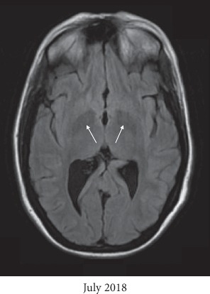 Manganese Neurotoxicity as a Complication of Chronic Total Parenteral Nutrition.