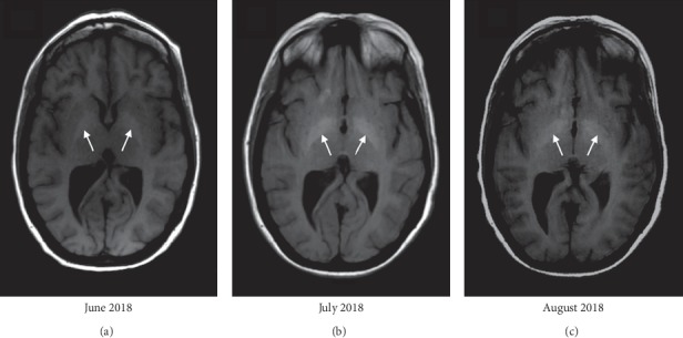 Manganese Neurotoxicity as a Complication of Chronic Total Parenteral Nutrition.