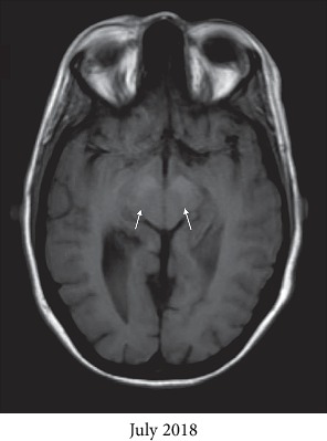 Manganese Neurotoxicity as a Complication of Chronic Total Parenteral Nutrition.