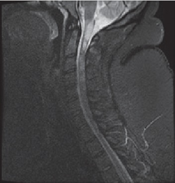 Medically Refractory Multiple Sclerosis Is Successfully Treated with Plasmapheresis in a Super Morbidly Obese Pregnant Patient.