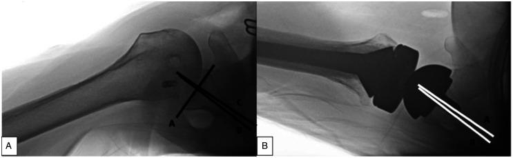 Do Preoperative and Postoperative Glenoid Retroversion Influence Outcomes After Reverse Total Shoulder Arthroplasty?