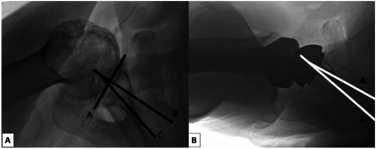 Do Preoperative and Postoperative Glenoid Retroversion Influence Outcomes After Reverse Total Shoulder Arthroplasty?