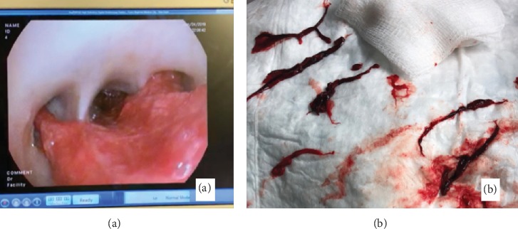 Massive Pulmonary Hemorrhage from Bronchial Varix.