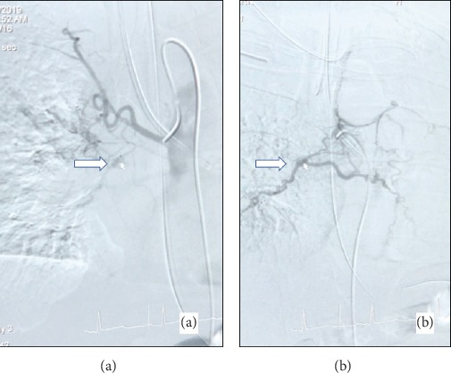 Massive Pulmonary Hemorrhage from Bronchial Varix.