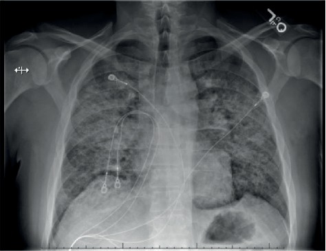 Vaping-Induced Lung Injury: A Case of Lipoid Pneumonia Associated with E-Cigarettes Containing Cannabis.