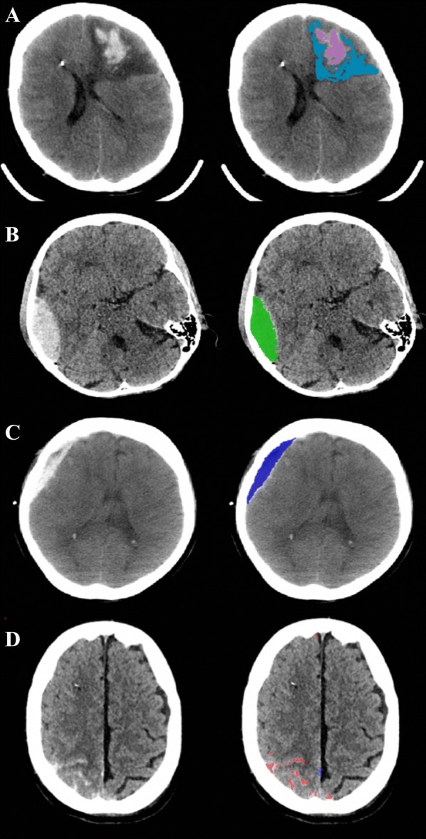Relationship Between Measures of Cerebrovascular Reactivity and Intracranial Lesion Progression in Acute TBI Patients: an Exploratory Analysis.
