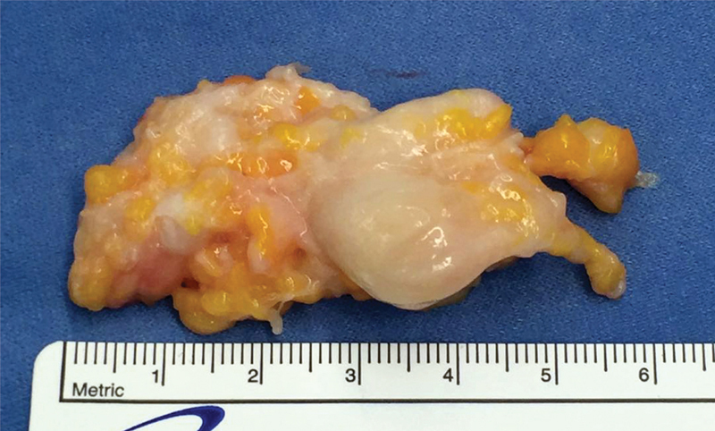 Five Centimeters Morton's Neuroma in a 46-Year-Old Woman Affected by Macrodactily.