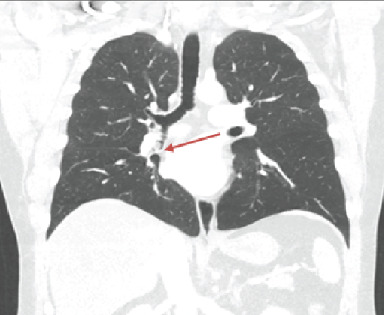 A Rare Cause of Cough: Tracheobronchial Myxoid Spindle Cell Lipoma.