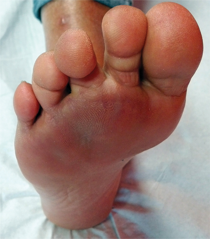 Five Centimeters Morton's Neuroma in a 46-Year-Old Woman Affected by Macrodactily.