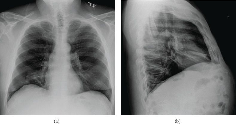 A Rare Cause of Cough: Tracheobronchial Myxoid Spindle Cell Lipoma.