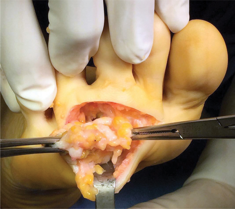 Five Centimeters Morton's Neuroma in a 46-Year-Old Woman Affected by Macrodactily.