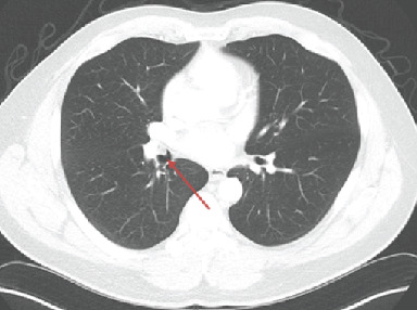 A Rare Cause of Cough: Tracheobronchial Myxoid Spindle Cell Lipoma.