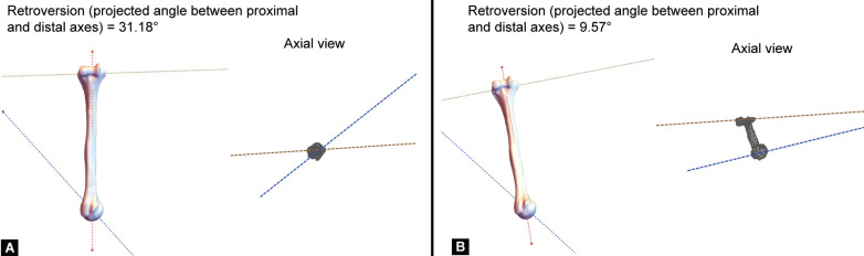 Humeral Retroversion (Complexity of Assigning Reference Axes in 3D and Its Influence on Measurement): A Technical Note.