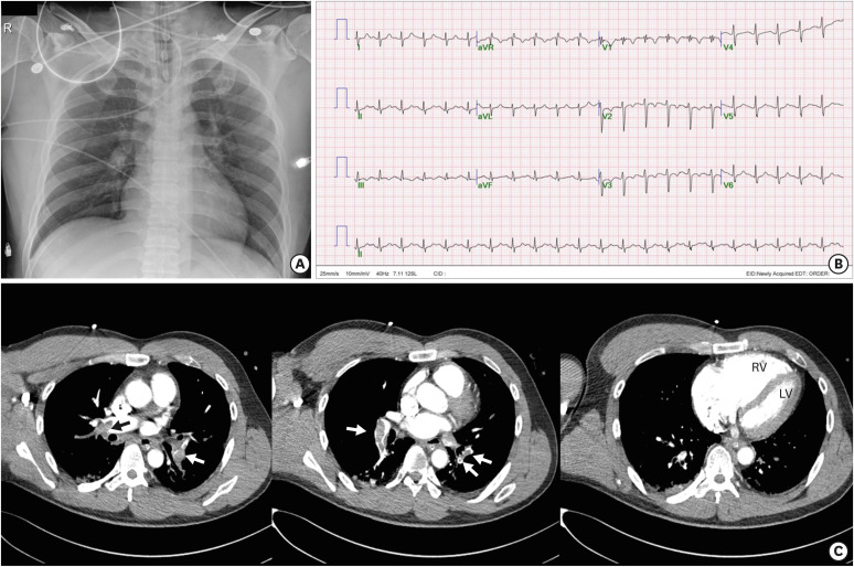 In-Hospital Outcome in Patients Underwent Extracorporeal Membrane Oxygenation in Life-Threatening High-Risk Pulmonary Embolism.