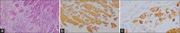 Development of clinico-histopathological predictive model for the assessment of metastatic risk of oral squamous cell carcinoma.